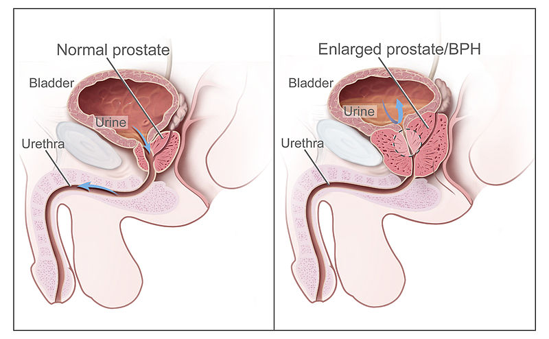 prostaty