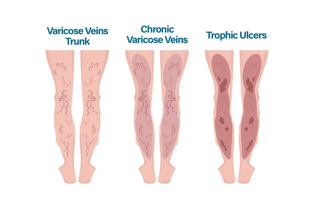 La diferencia entre las venas varicosas y las arañas vasculares